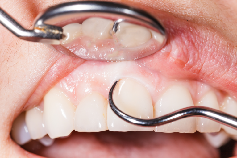 Diş Eti Hastalıkları Şile Ağız ve Diş Polikliniği